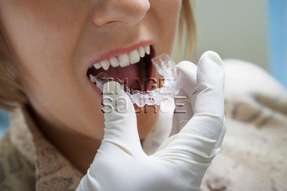 Anpassung einer Zahnschiene
